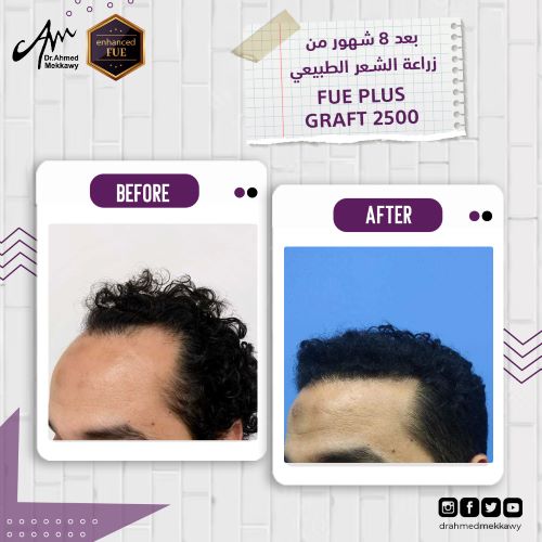 تقنية FUE لزراعة الشعر